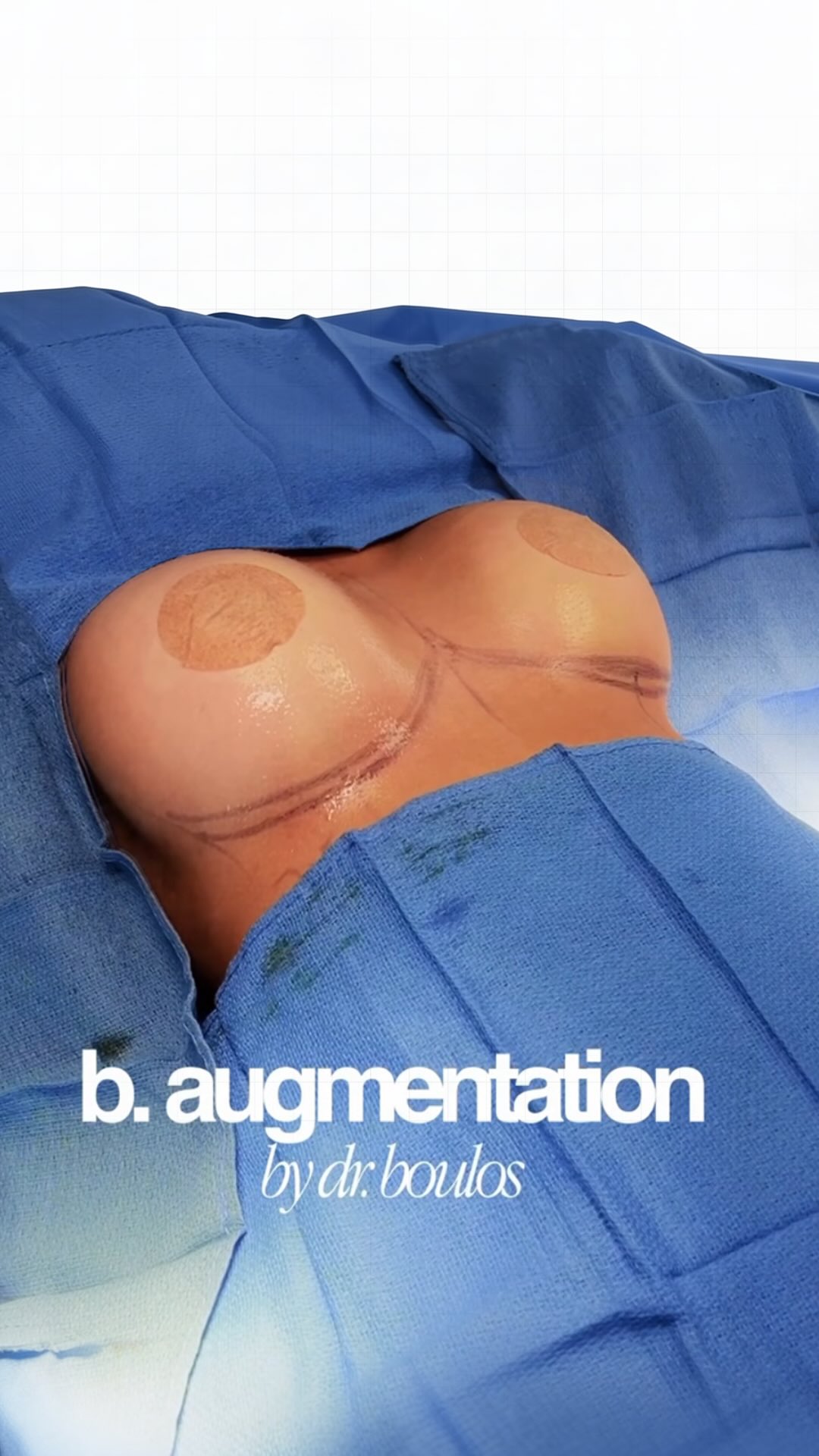 💅Con el derecho del doctor Boulos esta hermosa paciente  fue transformada en una Barbie después de 
